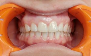 zęby po higienizacji