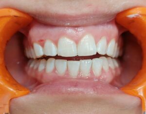 zęby po higienizacji pro3